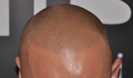 Scalp-Pigmentation-Treatment