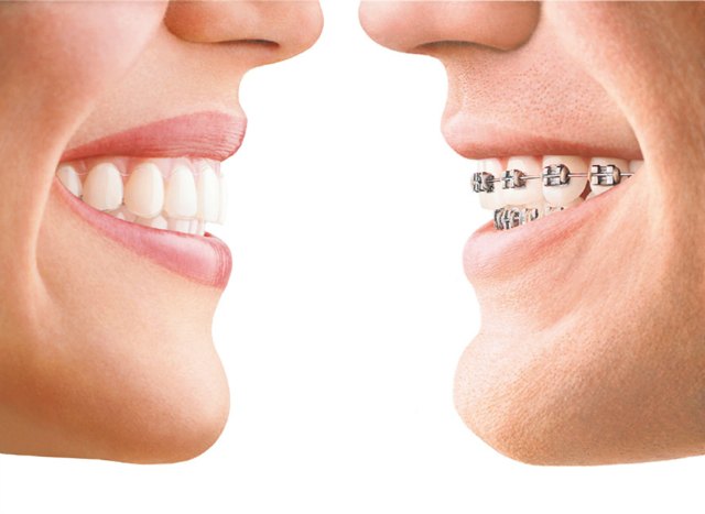 Invisalign Braces