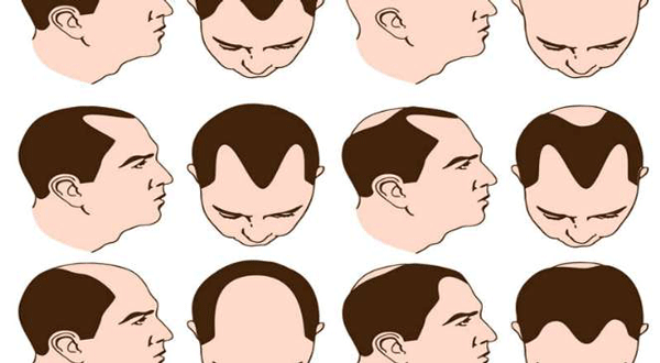 male-pattern-baldness