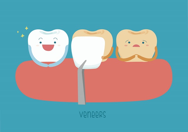 dental-veneers-melbourne